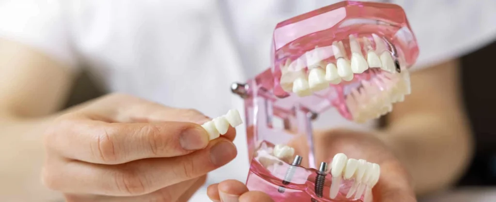 chirurgien dentiste protheses l isle adam Implants dentaires Dr Ludovic Zeitoun - Chirurgien-dentiste à L'Isle-Adam