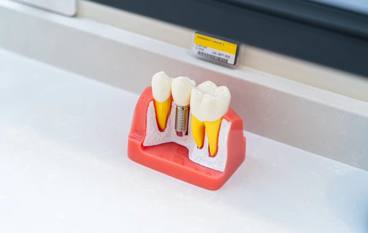 mxl Implants dentaires Dr Ludovic Zeitoun - Chirurgien-dentiste à L'Isle-Adam