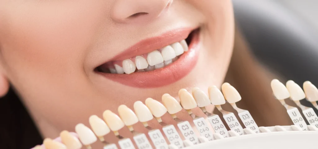 dr ludovic zeitoun implants auvers sur oise Les facettes : l’esthétique du sourire Dr Ludovic Zeitoun - Chirurgien-dentiste à L'Isle-Adam