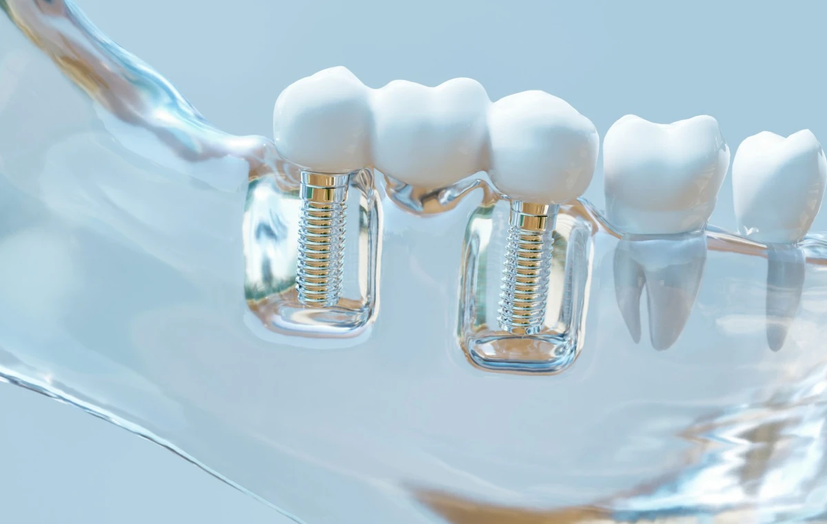 bridge implant Prothèses dentaires Dr Ludovic Zeitoun - Chirurgien-dentiste à L'Isle-Adam