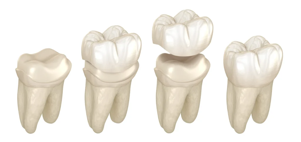 dr ludovic zeitoun implants l isle adam Soins des caries Dr Ludovic Zeitoun - Chirurgien-dentiste à L'Isle-Adam