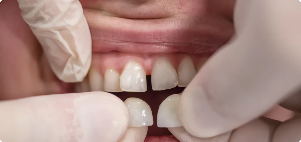 facettes scaled Les facettes : l’esthétique du sourire Dr Ludovic Zeitoun - Chirurgien-dentiste à L'Isle-Adam